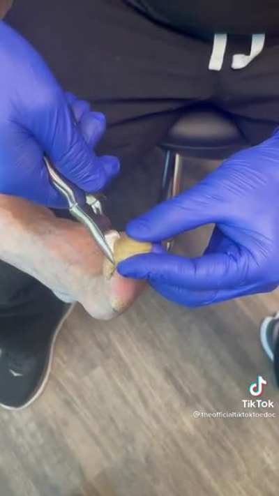 Painfully long toe nails