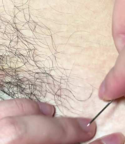 small bikini line ingrown