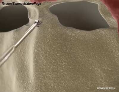 How Brain Tumors are removed!
