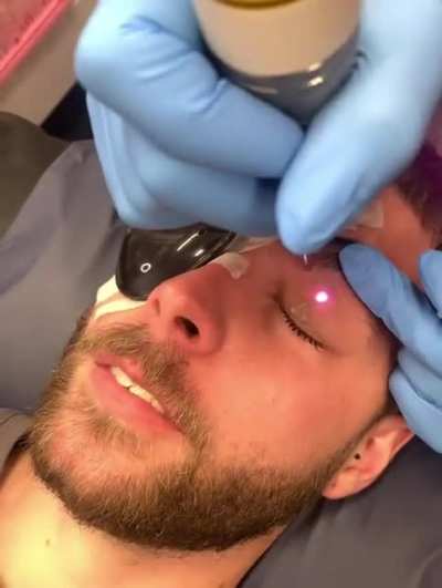 Laser treatment on an eyelid tattoo
