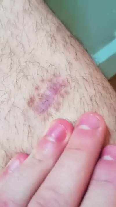 I have a scar thats so thin you can see the bone underneath.