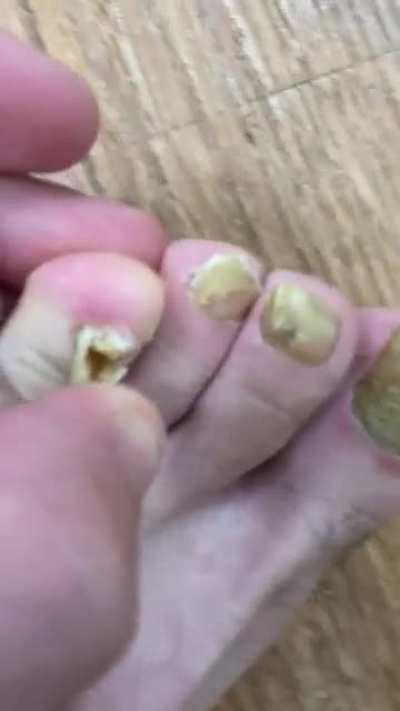 My loose, ingrown toena<wbr>ils🦶🤢