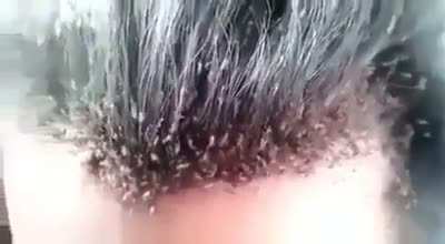 Lice on his head