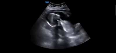 Scan of Baby in the Womb When the Mother Laughs