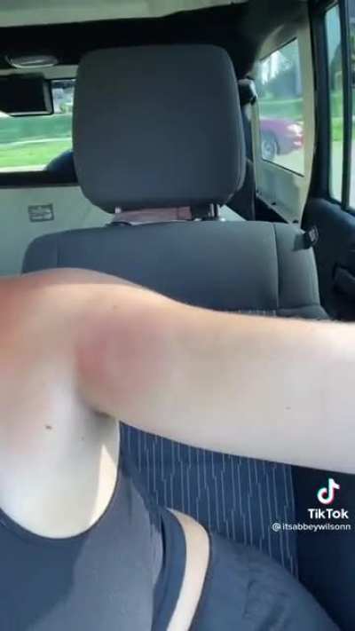 Stung by a bee 🐝