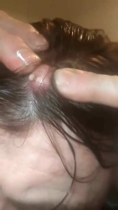 Cyst on the head