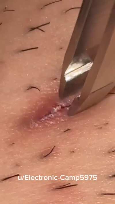 Ingrown hair 😱