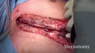 Donor lung retrieval technique for lung transplant