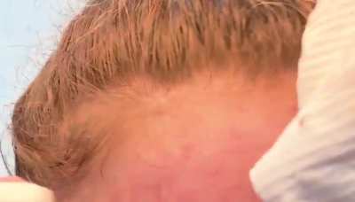 small pimple on my forehead